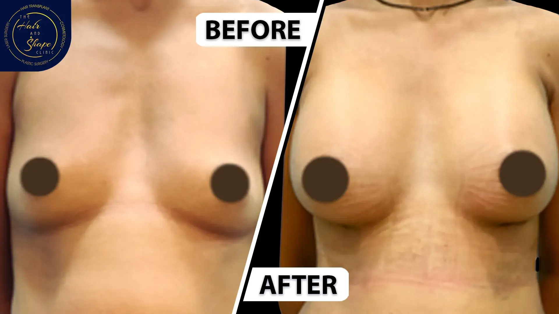 Breast Augmentation result4